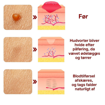 DermaCure™ | Fjerner vorter og alderspletter – smertefrit inden for 3 dage!