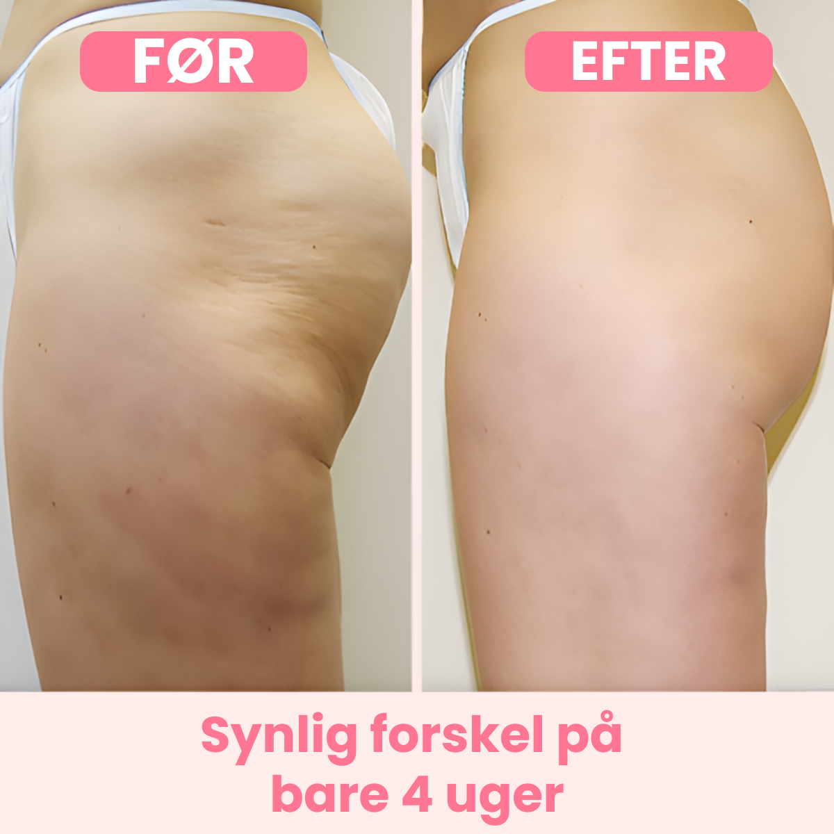 CelluFree™ – frihed fra cellulite